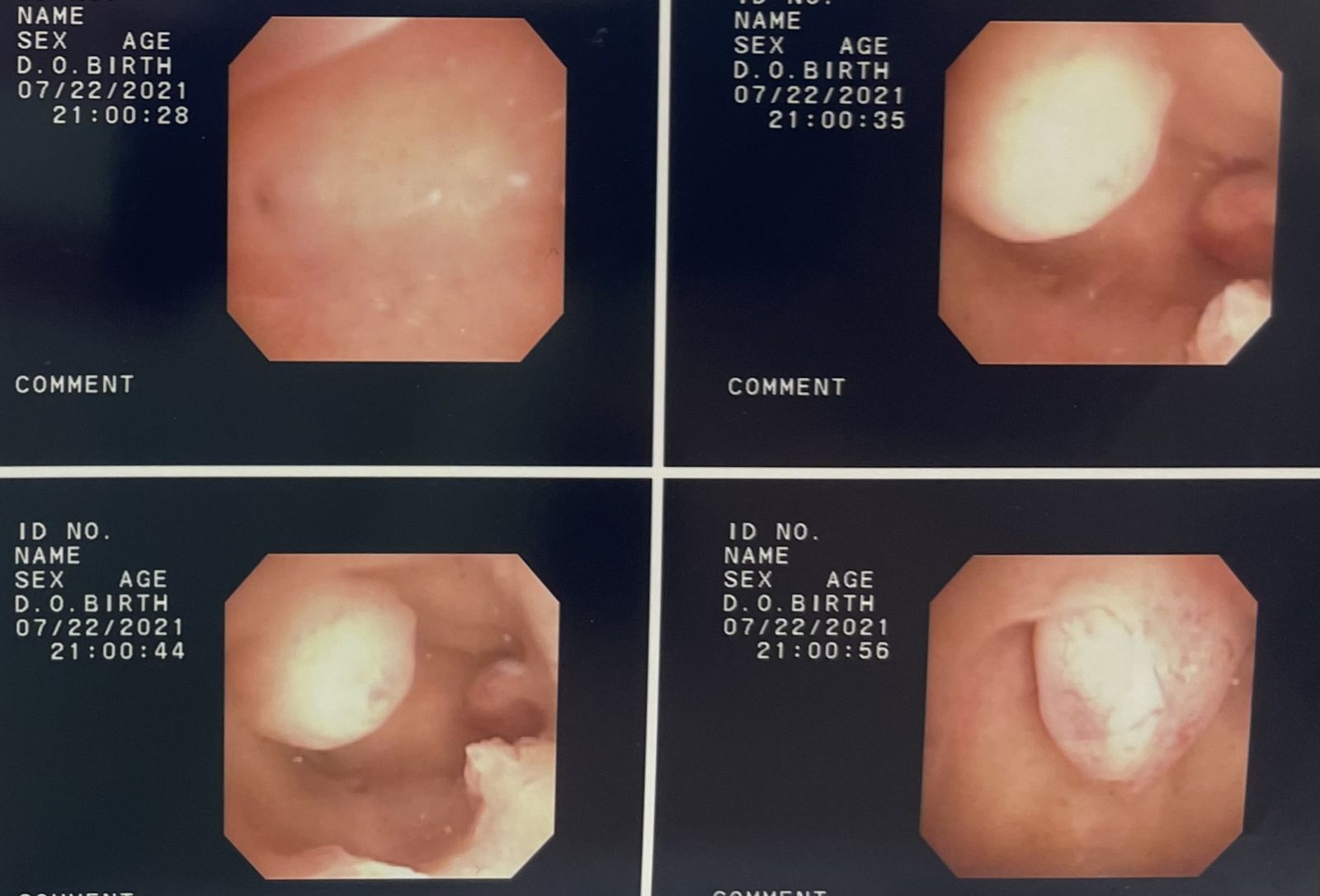 試管嬰兒治療之前，如何評估子宮腔的狀況